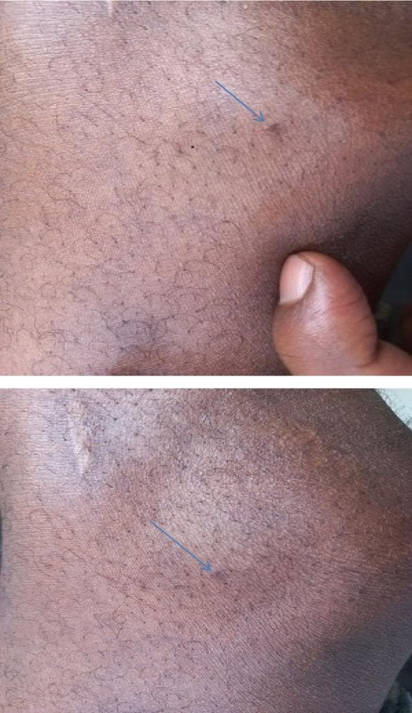 This clinical photograph shows a close-up of a skin lesion on the lateral aspect of the left knee of a patient with dark complexion. The image is split into two panels, both utilizing a blue arrow to indicate the primary site of interest. The lesion consists of a tiny, dark, circular puncture mark, consistent with a fang mark from a Latrodectus (black widow spider) bite. The surrounding skin exhibits minimal inflammatory response, with no significant erythema, edema, or induration visible in the immediate area. The skin texture is generally smooth with normal hair distribution and fine surface lines. A clinician's thumb is visible in the upper panel providing a scale for the lesion's minute size. This visual serves as a teaching tool for recognizing the subtle local dermatological findings often associated with latrodectism, where systemic symptoms (such as muscle pain and autonomic instability) typically outweigh visible skin trauma.