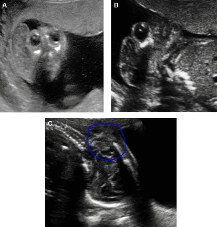 This composite diagnostic image features three grayscale fetal ultrasound panels (A, B, and C) illustrating different types of neural tube defects (NTDs) in the second trimester.
Panel A shows anencephaly, characterized by the absence of the cranial vault and cerebral hemispheres; the protruding orbits and residual neural tissue create the classic 'Mickey Mouse' sign in a coronal or transverse view.
Panel B demonstrates an encephalocele, specifically an occipital myelomeningocele, visualized as a fluid-filled, sac-like protrusion through a defect in the occipital bone.
Panel C displays a longitudinal view of the fetal spine with a thoracolumbar myelomeningocele (highlighted by a blue circle). This view reveals a disruption in the spinal line with a cystic mass protruding from the posterior aspect of the vertebrae, indicative of spina bifida aperta where the spinal cord and meninges are exposed.
The collection serves as an educational reference for prenatal screening and the sonographic identification of major congenital central nervous system malformations.