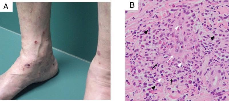 This composite image illustrates the clinical and histological features of systemic vasculitis. Panel A is a clinical photograph of the lower extremities showing multiple, discrete to confluent, erythematous to violaceous macules and papules, consistent with palpable purpura. The lesions are concentrated around the ankles and shins. Panel B is a light microscopy image of a skin biopsy stained with Hematoxylin and Eosin (H&E) at x200 magnification, demonstrating characteristic findings of leukocytoclastic vasculitis with eosinophilic involvement. Key histological features include fibrinoid necrosis of the vessel wall (white arrow), nuclear dust or leukocytoclasis (black arrows), and significant dermal extravascular leakage of red blood cells (white arrowheads). A prominent inflammatory infiltrate is visible, containing numerous eosinophils (black arrowheads) along with neutrophils and macrophages. These findings are clinically significant for diagnosing small-vessel vasculitis, such as Eosinophilic Granulomatosis with Polyangiitis (EGPA) or MPA-related eosinophilic vasculitis.