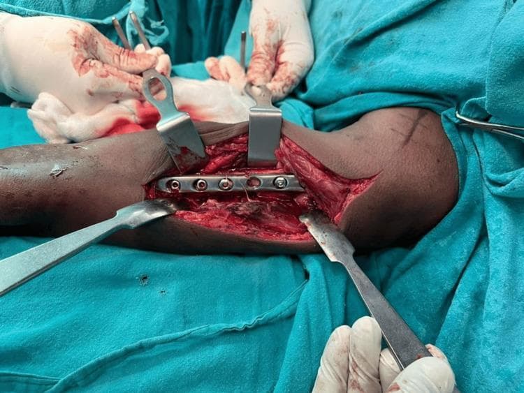 This clinical photograph captures an intraoperative view of an open reduction and internal fixation (ORIF) of a humeral fracture. The surgical site is prepared with blue sterile drapes and accessed via an anterolateral Henry’s approach. Several metallic surgical retractors (including Hohmann-style and right-angle retractors) are positioned to maintain visualization of the surgical field by retracting the biceps and brachialis muscles. A stainless steel orthopedic locking compression plate (LCP) or limited contact dynamic compression plate (LC-DCP) is shown positioned over the anterolateral surface of the humerus. Several screw holes are visible in the plate, with some already occupied by cortical or locking screws to stabilize the bone fragments. The image demonstrates the critical steps of alignment and hardware placement in orthopedic trauma surgery. Visible landmarks include the flexed elbow with skin markings and the deep exposure of the humeral shaft, emphasizing the relationship between the implant and the underlying musculoskeletal anatomy.