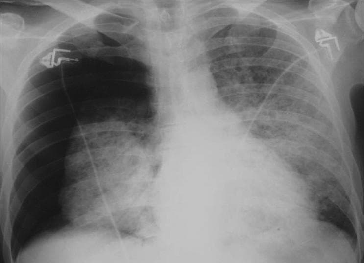 This diagnostic image is a posterior-anterior (PA) chest X-ray demonstrating a large spontaneous right-sided pneumothorax and bilateral interstitial disease. The right hemithorax shows a clear visceral pleural line with a significant peripheral area devoid of lung markings, particularly in the apical and lateral regions, representing approximately 50% lung collapse. Medially, the collapsed right lung and the entire left lung exhibit diffuse, symmetric ground-glass opacities and reticular interstitial markings. These findings are highly characteristic of Pneumocystis jirovecii (formerly carinii) pneumonia (PCP) in the setting of immunocompromise. No significant pleural effusion or mediastinal shift is visualized. Radiopaque medical monitoring electrodes and leads are visible on the upper chest. The radiographic presentation highlights a common complication of PCP, where cystic changes or subpleural blebs lead to spontaneous pneumothorax. Target audience: medical students and radiology residents studying opportunistic infections in HIV/AIDS.