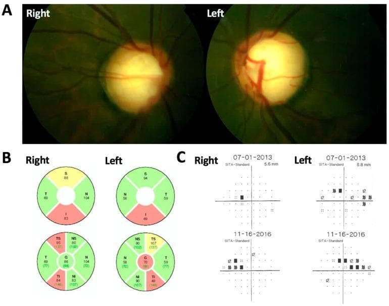 This composite ophthalmological image presents clinical assessments for juvenile open-angle glaucoma (JOAG). Panel A displays bilateral fundus photographs showing advanced glaucomatous optic neuropathy, characterized by severe optic disc cupping with a cup-to-disc ratio of approximately 0.9 and marked pallor in both the right and left eyes. Panel B presents Optical Coherence Tomography (OCT) Retinal Nerve Fiber Layer (RNFL) thickness maps. These circular charts utilize color-coding (green for normal, yellow for borderline, and red for thinning) to demonstrate significant thinning in the superior and inferior quadrants bilaterally. Panel C shows Humphrey Visual Field (HFA) SITA-Standard tests over a three-year progression (2013 to 2016). The right eye displays a developing superior nasal step defect, while the left eye shows more advanced progression of both superior and inferior nasal field loss. The combination of high cup-to-disc ratios, structural RNFL loss on OCT, and corresponding functional visual field defects illustrates the diagnostic triad of advanced glaucoma progression.