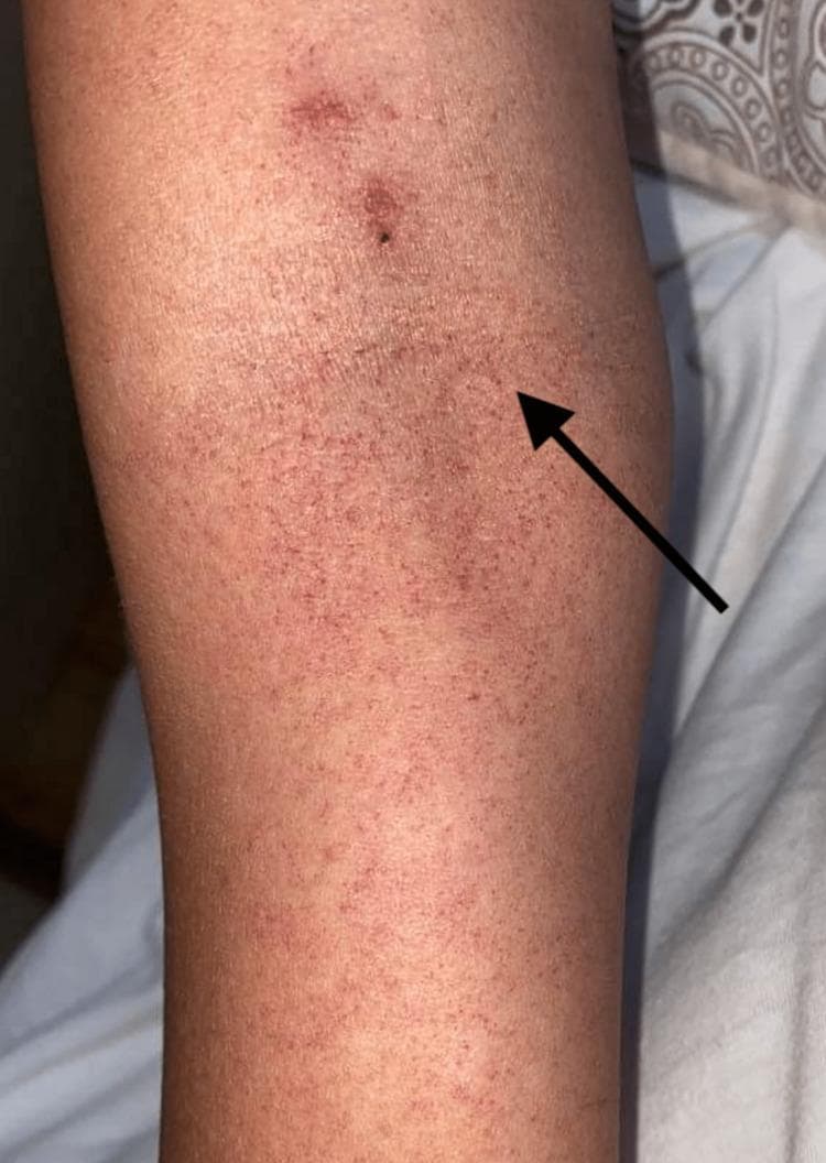 This clinical photograph displays a human extremity featuring a widespread, non-blanching petechial rash. The lesions are small, approximately 1-2 mm in diameter, appearing as reddish-purple punctate spots. They are distributed with varying density across the skin surface, creating a mottled, purpuric appearance. A black arrow points to a representative cluster of these petechiae. In the proximal portion of the image, there is a slightly larger, darker, and more confluent erythematous lesion, which may represent ecchymosis or evolving purpura. This image demonstrates characteristic dermatological manifestations often associated with systemic conditions such as thrombocytopenia, coagulopathies, or viral hemorrhagic fevers like Dengue. It is a valuable resource for medical education in dermatology, hematology, and infectious diseases, illustrating the morphology and distribution of microvascular hemorrhages in the skin.
