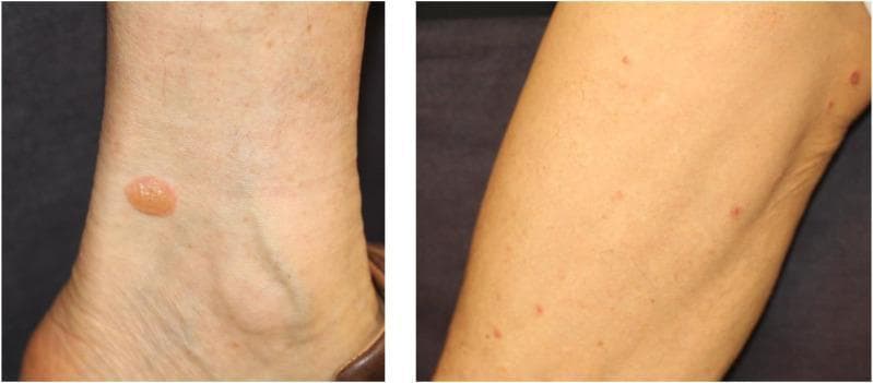 Two clinical photographs demonstrate a bullous pemphigoid eruption on the lower extremities. The left image shows a solitary, tense, fluid-filled bulla located near the medial malleolus of the ankle. The lesion is approximately 1-1.5 cm in diameter, circular, with a translucent, yellowish serous content and a smooth, intact roof. The right image shows multiple, smaller, erythematous papules and early bullae distributed across the leg. In both views, the surrounding skin appears largely non-erythematous and lacks significant peri-lesional inflammation. These findings are characteristic of an autoimmune bullous disease, often presenting as an immune-related adverse event (irAE) following immune checkpoint inhibitor therapy. The clinical significance of these tense bullae lies in their subepidermal origin, which distinguishes them from the flaccid bullae seen in pemphigus vulgaris. This material is suitable for dermatology and oncology educational indexing.