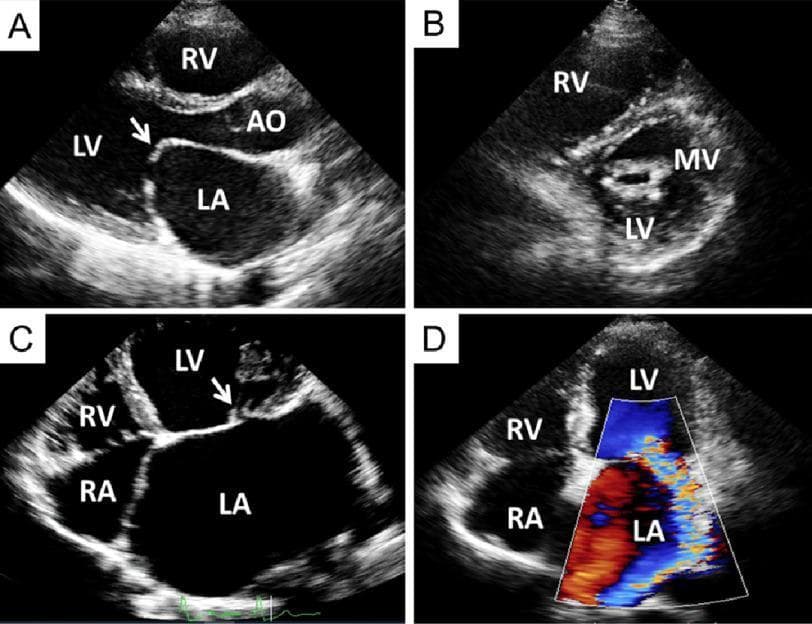 This composite diagnostic image displays four transthoracic echocardiography (TTE) views demonstrating manifestations of rheumatic heart disease on the mitral valve. Panel A (Parasternal Long-Axis View) shows severe mitral stenosis characterized by thickened leaflets and the classic 'hockey stick' deformity of the pliable anterior mitral valve leaflet during diastole (white arrow). Panel B (Parasternal Short-Axis View) highlights the 'fish-mouth' appearance of the mitral valve orifice caused by commissural fusion. Panel C (Apical Four-Chamber View) demonstrates chronic mitral regurgitation with a notable coaptation defect (arrow) and a severely dilated left atrium (LA) relative to the left ventricle (LV). Panel D applies color flow Doppler mapping to the apical four-chamber view, showing a prominent, turbulent regurgitant jet (mosaic color pattern) flowing from the LV back into the LA, confirming severe mitral regurgitation. Anatomical labels include RA (right atrium), RV (right ventricle), and Ao (aorta). This sequence is used for clinical education on valvular assessment, specifically for identifying morphology and hemodynamic severity in rheumatic heart disease.
