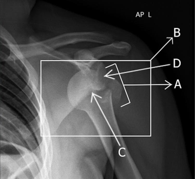Anterior-posterior (AP) X-ray of the left shoulder demonstrating an anterior glenohumeral joint dislocation accompanied by an associated fracture. The humeral head (labeled C) is displaced anteriorly and inferiorly relative to the glenoid fossa (labeled D), appearing medially beneath the coracoid process. An avulsion fracture of the greater tuberosity is visible (labeled A and B), appearing as a cortical fragment separated from its original anatomical position on the proximal humerus. The diagnostic image highlights key orthopedic pathology including joint space widening, loss of normal articulation, and traumatic osseous injury. This visual is significant for medical education regarding shoulder trauma, dislocation classifications, and the identification of associated fractures in surgical and emergency medicine contexts.