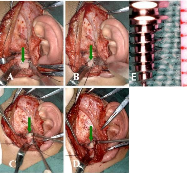 This composite of clinical photographs and a macro image details an open temporomandibular joint (TMJ) disc repositioning surgery using titanium anchors. Panels A through D show the surgical field accessed via a preauricular incision. Key anatomical structures include the mandibular condyle and the displaced articular disc. Panel A demonstrates the insertion of a titanium anchor into the posterior slope of the condylar head (indicated by a green arrow). Panel B shows Ethibond sutures secured to the anchor. Panels C and D illustrate the articular disc being repositioned and stabilized over the condyle using a horizontal mattress suture technique. Surgical instrumentation including retractors, forceps, and needle holders are visible throughout the procedure. Panel E provides a high-magnification view of the titanium anchor, characterized by a cylindrical, threaded screw design with a wide head for suture attachment, resting against a surgical drape for scale. This sequence serves as an educational resource for maxillofacial surgery, specifically addressing the management of internal derangement of the TMJ through surgical disc plication.