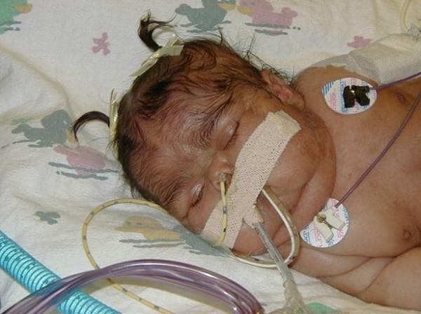 Clinical photograph of a neonate demonstrating characteristic facial features of neonatal Cushing syndrome. The infant displays 'moon facies,' characterized by a rounded face with prominent, full cheeks. Visible facial plethora (reddish discoloration) and hirsutism (excessive hair growth on the face and forehead) are present. The infant is shown in a medical setting, evidenced by intensive care monitoring and support devices. Visible equipment includes nasal prongs or a nasogastric tube secured with tan adhesive tape across the midface, and circular ECG electrodes with lead wires attached to the chest for cardiac monitoring. The clinical presentation is highly suggestive of hypercortisolism, potentially as a component of McCune-Albright Syndrome (MAS), where such signs are often associated with café-au-lait spots and polyostotic fibrous dysplasia.