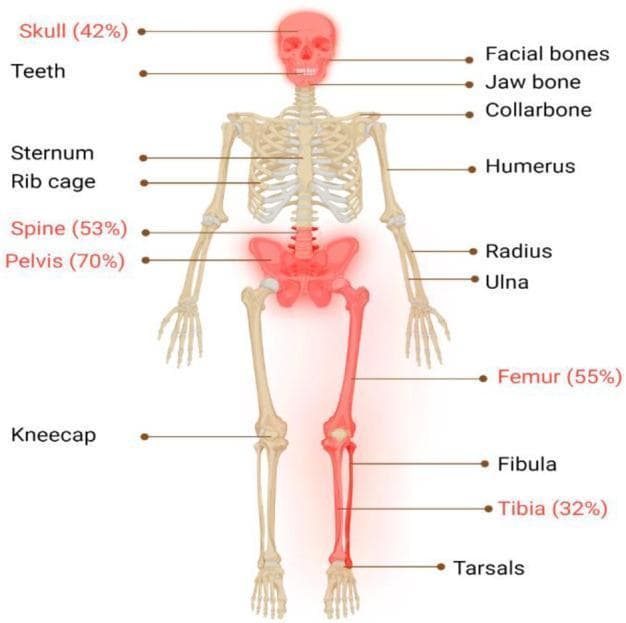 Anatomical diagram of a full human skeleton in an anterior view, illustrating the distribution and incidence rates of Paget's Disease of Bone (PDB). The diagram uses color-coding to highlight the most frequently affected skeletal sites. The primary regions highlighted in red include the skull (42%), lumbar spine (53%), pelvis (70%), femur (55%), and tibia (32%), demonstrating the disease's predilection for the axial skeleton and long bones. Other anatomical structures labeled for reference include the facial bones, jaw bone, collarbone, humerus, sternum, rib cage, radius, ulna, kneecap, fibula, and tarsals. This infographic serves as an educational tool to visualize the epidemiological patterns of PDB, emphasizing that while the disorder can be polyostotic, certain landmarks like the pelvis and femur show significantly higher involvement rates. The visual contrast between the highlighted red areas and the neutral-toned bone helps medical students and clinicians identify common sites for clinical and radiological investigation.