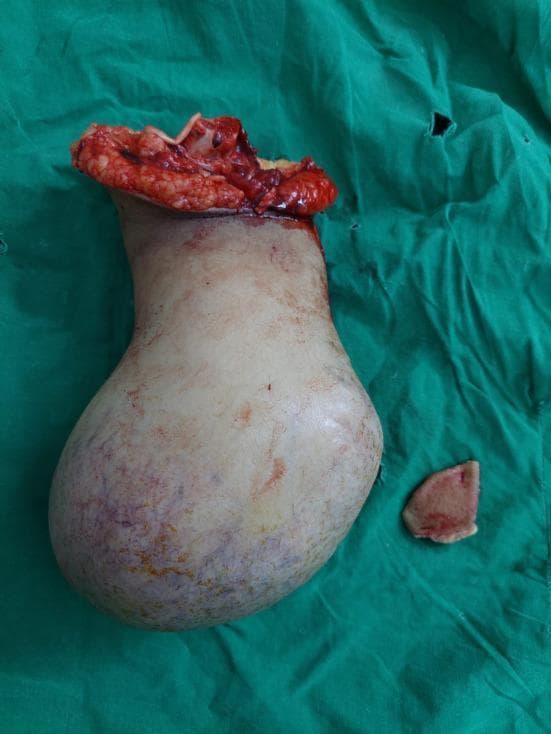 Clinical photograph of a gross surgical specimen following a below-elbow amputation for recurrent osteosarcoma. The specimen consists of an amputated limb segment, likely the forearm and distal stump, exhibiting a massive, bulbous expansion of the distal end. The skin over the enlarged area is pale, taut, and displays a mottled appearance with reddish and purplish vascular discoloration, suggesting an underlying aggressive tumor. The proximal surgical margin shows a traumatic, hemorrhagic transection site with visible subcutaneous fat, muscle tissue, and potentially bone fragments. The global appearance characterizes a localized recurrence of a high-grade bone malignancy in a limb stump. The specimen is displayed on a green sterile surgical drape, and a small, detached biopsy or tissue fragment is seen adjacent to the main mass. This image serves as a pathology specimen study of musculoskeletal oncology, illustrating the gross morphology of tumor recurrence and its impact on limb architecture.