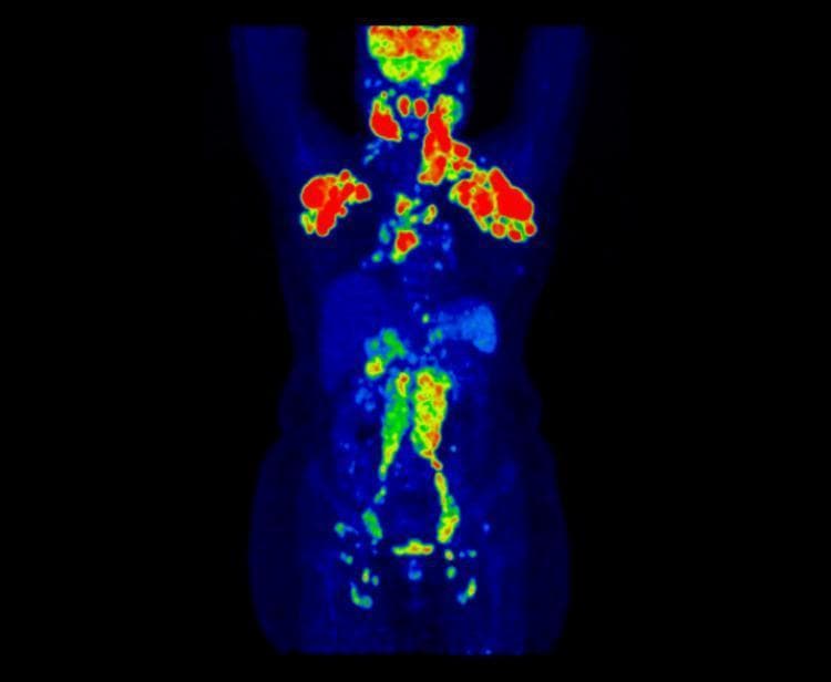 This diagnostic image is a whole-body Maximum Intensity Projection (MIP) from an 18F-FDG PET-CT scan, demonstrating widespread lymphadenopathy. The coronal projection utilizes a false-color heat map where red and yellow represent high metabolic activity (SUVmax) against a blue background of low tracer uptake. There is significant, bilateral hypermetabolic activity in the cervical and supraclavicular regions, axillary lymph nodes, and mediastinum. Furthermore, the scan reveals increased tracer uptake in the retroperitoneal, pelvic, and bilateral inguinal lymph node chains, spanning both sides of the diaphragm. The intensity of FDG avidity is most pronounced in the upper body (cervical and axillary regions) and decreases in the lower abdominal and pelvic regions. This presentation is characteristic of systemic inflammatory or neoplastic processes involving the lymphatic system, such as lymphoma or inflammatory myofibroblastic tumors, requiring histological correlation.