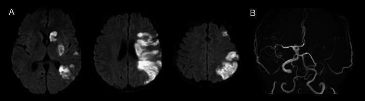 This composite diagnostic image features brain MRI findings from a patient with an acute ischemic stroke. Panel A consists of three axial slices of Diffusion-Weighted Imaging (DWI), which demonstrate acute cerebral infarctions in the left middle cerebral artery (MCA) territory. These infarctions are characterized by areas of restricted diffusion (hyperintensities). Visible pathology includes scattered embolic-pattern infarcts in the deep white matter and basal ganglia, as well as a large, confluent cortical infarct involving the left parietal lobe. Panel B shows a coronal view from a Magnetic Resonance Angiogram (MRA) of the intracranial circulation. The image reveals a significant obstruction or occlusion of the left internal carotid artery (ICA). Notable vascular findings include the absence of the normal arterial signal on the left side and the presence of fine, tortuous collateral vessels attempting to reperfuse the ischemic territory. This clinical imaging set highlights the relationship between proximal large vessel occlusion and subsequent multi-territory cortical and subcortical infarction, characteristic of thromboembolic events.