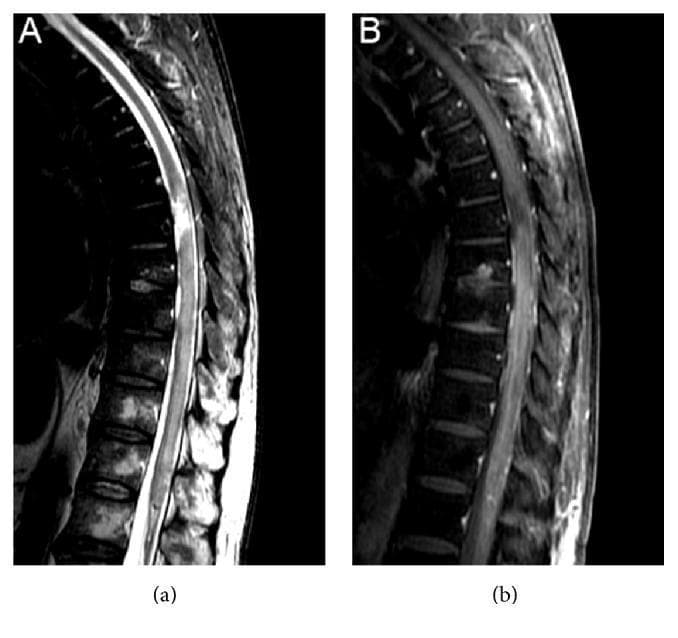 This diagnostic image pair displays sagittal MRI views of the thoracic and lumbar spinal cord, illustrating a case of longitudinally extensive transverse myelitis (LETM). Image A is a T2-weighted sagittal scan revealing a high signal intensity, hyperintense lesion within the cord. The lesion is tumefactive (swollen) and extends from the T6 vertebral level inferiorly to the medullary cone, with a more focal high-intensity signal noted specifically at the T6-T7 levels. Image B represents a post-contrast T1-weighted sagittal sequence of the same region. It demonstrates pathologic gadolinium enhancement within the previously identified T2-hyperintense areas, indicating active inflammation and a breakdown of the blood-spinal cord barrier. The visual findings are characteristic of extensive inflammatory or demyelinating processes of the central nervous system, such as those seen in neuromyelitis optica spectrum disorder (NMOSD) or post-infectious/post-vaccination myelitis.
