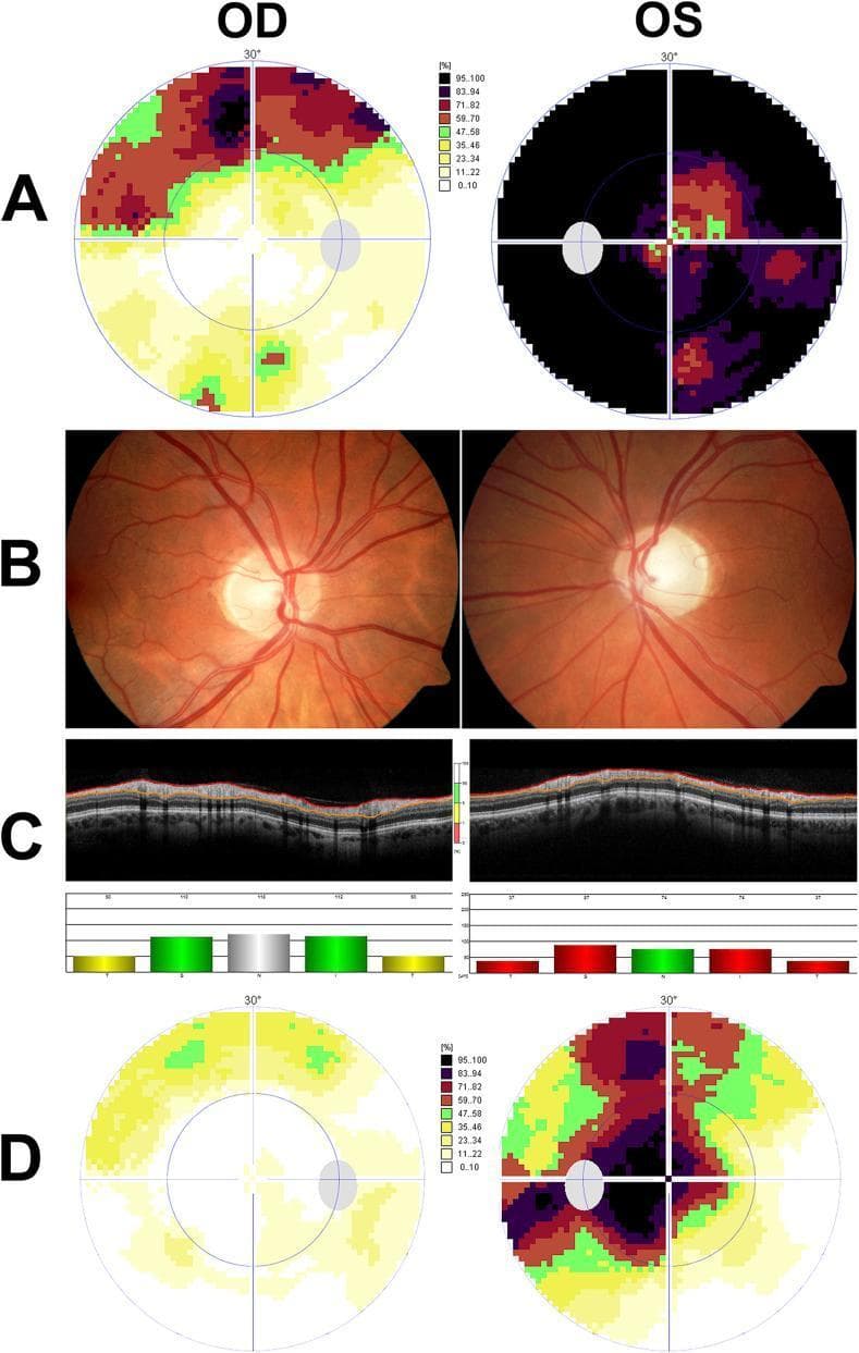 This composite educational graphic illustrates a neuro-ophthalmological workup for bilateral optic neuropathy. Panel A displays baseline threshold perimetry (visual field test) maps for the right (OD) and left eye (OS), showing an upper arcuate defect in the OD and profound, deep visual field loss in the OS. Panel B presents color fundus photographs; the right optic disc appears healthy, while the left optic disc demonstrates temporal pallor and mild cupping. Panel C shows peripapillary Optical Coherence Tomography (OCT) scans with associated Retinal Nerve Fiber Layer (RNFL) thickness bar graphs. The OD displays normal RNFL thickness (97 μm, green/yellow bars), whereas the OS shows significant pathological thinning (68 μm, red bars) falling below the reference range. Panel D displays follow-up threshold perimetry post-radiotherapy, indicating partial recovery of sensitivity in both eyes but with a persistent central scotoma in the left eye. These modalities collectively demonstrate the diagnosis and progression of optic nerve damage, relevant for clinical studies in neuro-oncology and ophthalmology.