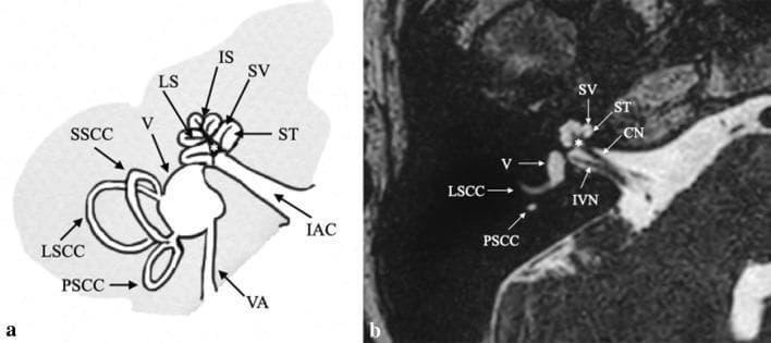 This educational composite depicts the normal anatomy of the human inner ear through an anatomical diagram (a) and a corresponding high-resolution axial MRI (b), specifically a 3D FIESTA sequence. The primary focus is the complex architecture of the bony and membranous labyrinth. Key structures identified include the cochlea, which is shown spiraling around the central modiolus (asterisk), with clear labeling of the scala vestibuli (SV), scala tympani (ST), and the dividing interscalar septum (IS) and osseous spiral lamina (LS). The vestibular system is represented by the vestibule (V), the lateral (LSCC), posterior (PSCC), and superior (SSCC) semicircular canals, and the vestibular aqueduct (VA). The diagnostic MRI correlates these illustrations with clinical findings, showing the cochlear nerve (CN) and inferior vestibular nerve (IVN) within the internal acoustic canal (IAC). This comparison is designed to teach medical students and radiology residents the spatial relationships and internal architecture of the temporal bone's auditory and vestibular apparatus.