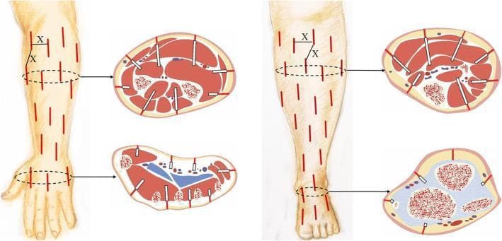 An anatomical and surgical diagram illustrating a reticular mini-incision decompression technique for osteofascial compartment syndrome (OCS). The figure displays two anatomical regions: the upper extremity (forearm and hand) and the lower extremity (leg and foot). A longitudinal view of each limb shows a pattern of multiple, short, parallel red lines representing skin incisions, approximately 0.5–1.0 cm apart (labeled as 'X'). Corresponding cross-sectional diagrams demonstrate the surgical depth of these incisions. The cross-sections show the incisions extending through the skin and subcutaneous tissue to reach the deep fascia. White instrument indicators (representing vascular clamps) are shown separating the subcutaneous and deep fascial layers to facilitate compartment release. Key anatomical structures visible in the cross-sections include muscle compartments, bones (tibia, fibula, radius, ulnar), and major vascular bundles. The diagram serves as a surgical protocol for minimally invasive fasciotomy, highlighting the spatial distribution of incisions required to achieve adequate tissue decompression while minimizing wound morbidity.