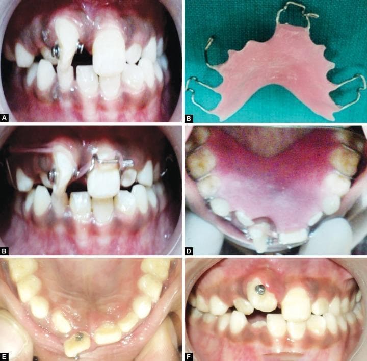 This series of clinical intraoral photographs documents the orthodontic management of a severely mesiolabially rotated maxillary right central incisor in a pediatric patient. Panel A shows bondable buttons attached to the labial and palatal surfaces of the rotated tooth. Panel B displays a custom-fabricated removable appliance featuring a pink acrylic base plate and metallic wire components, including a modified Adam’s clasp with a distal extension for anchorage and loops for elastic engagement. Panels C and D illustrate the appliance in situ, demonstrating the use of orthodontic elastics stretched between the bondable buttons and the wire extensions to provide a couple force for derotation. Panels E and F show the progress of the tooth movement, with the incisor achieving a more favorable alignment after four months of traction. The images serve as an educational resource for pediatric dentistry and orthodontics, highlighting the use of removable appliances and auxiliary attachments for the correction of severe localized malocclusions in mixed dentition.