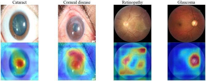A multi-panel comparison showing ocular surface photographs and retinal fundus images alongside corresponding deep learning saliency (heat) maps for four major eye diseases: Cataract, Corneal disease, Retinopathy, and Glaucoma. The top row presents the clinical images: the cataract photograph shows lens opacification; the corneal disease image demonstrates loss of transparency and neovascularization; the retinopathy and glaucoma images show retinal fundus views. The bottom row displays heatmaps generated via Grad-CAM, indicating the regions of diagnostic focus for the AI model. In Cataract, attention is centered on the pupillary area. In Corneal disease, high attention (red) corresponds to corneal lesions. In Retinopathy, attention is distributed across retinal vessels and the optic disc. In Glaucoma, attention is highly concentrated specifically on the optic nerve head and disc area. This visualization demonstrates the diagnostic logic of a hierarchical deep learning framework for ophthalmological screening, mapping visual features to specific anatomical regions of interest for various clinical classes.