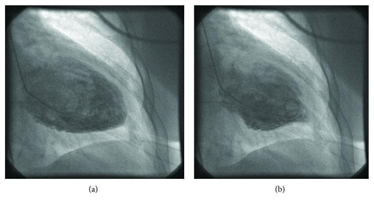 This diagnostic image consists of two frames from a left ventriculogram in a side-by-side comparison, representing diastole (a) and systole (b). The imaging modality is fluoroscopic angiography, used to assess cardiac chamber morphology and wall motion. In the diastolic frame, the left ventricular chamber is shown fully expanded and opacified with radiopaque contrast, exhibiting a rounded, dilated appearance. In the systolic frame, there is a distinct lack of significant volumetric reduction, indicating severe global systolic dysfunction. Notably, the mid-cavitary region shows persistent ballooning and hypokinesis, while the basal and apical segments exhibit relatively higher degrees of inward displacement. This visual pattern is characteristic of a mid-ventricular variant of Takotsubo cardiomyopathy (stress-induced cardiomyopathy). The clinical significance of these images is the demonstration of transient wall motion abnormalities and reduced ejection fraction in the absence of obstructive coronary artery disease, essential for diagnosing acute heart failure syndromes triggered by physical or emotional stress.