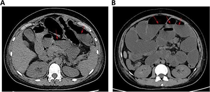 Two axial CT scans of the abdomen (Images A and B) demonstrating significant small bowel dilation and air-fluid levels, consistent with intestinal obstruction or pseudo-obstruction. Image A shows dilated loops of small bowel with a maximum diameter of approximately 45 mm. Several air-fluid levels are indicated by red arrows, characterized by horizontal interfaces between nondependent intraluminal gas and dependent fluid. Image B, a follow-up scan, depicts progressive dilation with bowel loops reaching up to 53 mm in diameter. The red arrows in Image B highlight more prominent and numerous air-fluid levels in the anterior abdominal cavity. There is a notable absence of a clear mechanical transition point, suggestive of a functional etiology such as intestinal pseudo-obstruction. The kidneys and vertebral body are visible posteriorly, providing anatomical orientation. These findings are used to illustrate the clinical hallmarks of bowel dysmotility and distension in an educational and diagnostic context.