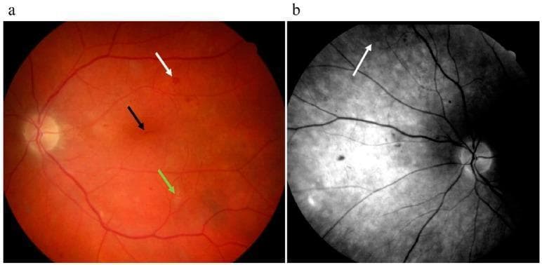This figure presents two clinical fundus images illustrating severe non-proliferative diabetic retinopathy (DR). Image (a) is a color fundus photograph displaying characteristic retinal microvascular complications. Key visible pathologies include a microaneurysm (black arrow) appearing as a small, focal red dot; an intraretinal hemorrhage (white arrow) shown as a larger, deeper red blot; and a soft exudate or 'cotton-wool spot' (green arrow) appearing as a fuzzy, off-white, ill-defined patch, indicating localized retinal ischemia. Image (b) is a red-free (monochrome) fundus photograph of the same patient, which enhances vascular contrast. It highlights Intraretinal Microvascular Abnormalities (IRMA), indicated by the white arrow, presenting as irregular, tortuous, and branching shunt vessels that represent a transition toward proliferative disease. These findings are clinically significant for the staging and management of diabetic eye disease, demonstrating the progression of vascular permeability and retinal hypoxia in Type 2 diabetic patients.