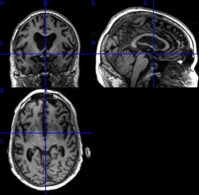 This diagnostic image displays a T1-weighted 3D MRI of the human brain presented in three orthogonal planes: coronal (top left), sagittal (top right), and axial (bottom left). The visualization uses cross-hair markers to indicate the precise anatomical intersection across these planes. The coronal view reveals the bilateral cerebral hemispheres, cortical gyri and sulci, and the central ventricular system. The sagittal view provides a midline perspective, clearly illustrating the cerebellum, brainstem (pons and medulla), corpus callosum, and the cingulate gyrus. The axial view displays a horizontal cross-section showing the basal ganglia regions, internal capsule, and the lateral ventricles. Tissue contrast demonstrates typical T1-weighting where gray matter appears darker than white matter, and cerebrospinal fluid (CSF) in the ventricles appears hypointense. Notably, the ventricles appear moderately enlarged, which is a feature often studied in the context of neurodegenerative conditions such as Alzheimer’s disease or Mild Cognitive Impairment (MCI). Blue orientation labels (S, I, L, R, A, P) facilitate anatomical referencing for neuroimaging research and clinical education.