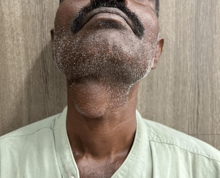 A clinical photograph of an adult male depicting a prominent midline neck mass, consistent with a thyroglossal duct cyst. The patient's neck is slightly extended, revealing a well-circumscribed, ovoid, and globular swelling located in the anterior midline of the neck, specifically at the level of the hyoid bone and inferior to the submental region. The overlying skin is intact and appears unremarkable, without signs of erythema, inflammation, ulceration, or fistulous tracts. This visual presentation is characteristic of a congenital thyroglossal duct anomaly, which typically manifests as a painless, mobile midline mass that often moves superiorly with tongue protrusion or swallowing. The image serves as a clinical example for Otolaryngology and General Surgery education, emphasizing the anatomical localization and physical characteristics necessary for the differential diagnosis of midline neck swellings, such as dermoid cysts or ectopic thyroid tissue.