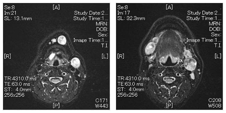 Two axial T2-weighted magnetic resonance imaging (MRI) slices of the neck at different anatomical levels demonstrate extensive bilateral cervical lymphadenopathy. The images show multiple enlarged, hyperintense (high signal intensity) rounded masses consistent with metastatic lymph nodes. In the superior slice, level Ia and right level Ib lymph nodes are prominently swollen, appearing as well-defined oval structures. In the inferior slice, a large heterogeneous hyperintense mass is visible at left level IIa, measuring approximately 37 mm, along with bilateral enlargement of level Ib nodes. These findings are consistent with metastatic spread from an oral cavity malignancy, specifically involving the submental (Level I) and upper jugular (Level II) chains. The images provide clinical evidence of nodal staging for head and neck squamous cell carcinoma (HNSCC), highlighting the use of MRI in assessing nodal size, signal characteristics, and anatomical distribution for treatment planning and surgical consideration.