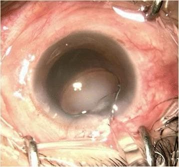 This intraoperative clinical photograph captures a human eye during cataract surgery, specifically demonstrating a rare acute opacification of an implanted trifocal intraocular lens (IOL). The image shows the anterior segment of the eye held open by surgical retractors, with a well-dilated pupil. Centered within the pupillary aperture, the implanted IOL optic exhibits a distinct, diffuse cloudiness or 'foggy' appearance, transitioning from its expected transparency to a semi-opaque white state. This phenomenon, often related to temperature fluctuations or material calcification, completely obscures the view of the posterior capsule. The surrounding iris and conjunctiva appear slightly hyperemic, typical of an ongoing surgical procedure. The photograph serves as a critical educational example of intraoperative IOL complications and material instability, highlighting the need for lens explantation when optical clarity is compromised immediately upon insertion.