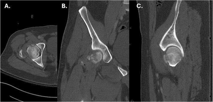 This diagnostic image consists of multiplanar computed tomography (CT) scans of the right hip in axial (A), coronal (B), and sagittal (C) views. The images demonstrate an acute femoral head fracture (Pipkin classification) with associated posterior hip dislocation. In the axial view (A), there is a visible disruption of the anterior-medial cortical margin of the femoral head. The coronal view (B) highlights comminution with small, hyperdense, displaced bone fragments situated within the inferior aspect of the acetabular fossa and hip joint space. The sagittal view (C) confirms cortical irregularity and loss of the normally smooth, spherical contour of the femoral head. These findings are clinically significant for orthopedic trauma assessment, illustrating the intra-articular nature of the fracture and the necessity of evaluating joint congruity following traumatic dislocation. The content is suitable for medical education focusing on musculoskeletal radiology and trauma management.