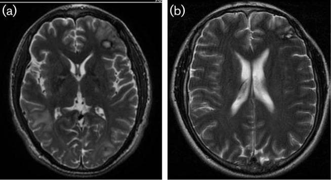 This diagnostic image pair displays axial T2-weighted magnetic resonance imaging (MRI) of the brain, comparing a pathological state with post-treatment resolution. Figure (a) illustrates multiple intracranial lesions consistent with granulomatous amoebic encephalitis, specifically Balamuthia mandrillaris. Key findings include an area of biopsy-related signal change in the left frontal region, extensive hyperintense perilesional oedema associated with a mass in the right temporal lobe, and hyperintense satellite lesions within the left frontal and parietal lobes. These lesions demonstrate characteristic T2-hyperintensity and mass effect. Figure (b) shows a follow-up MRI of the same patient taken two years into treatment, demonstrating significant clinical improvement. There is a complete resolution of the previously observed central nervous system (CNS) lesions, disappearance of the associated vasogenic oedema, and restoration of normal ventricular and sulcal anatomy. This comparison serves as a clinical timeline for the radiological monitoring of rare parasitic encephalitis under intensive therapy.