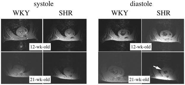 This diagnostic image set displays short-axis cine-MRI frames of the heart obtained at 9.4T, used for a comparative study of cardiac morphology. The panel is divided into two main sections: 'systole' and 'diastole,' featuring two rat models: the control Wistar-Kyoto (WKY) rat and the Spontaneously Hypertensive Rat (SHR). The images compare cardiac structures at 12 weeks and 21 weeks of age. In the systole phase, the ventricular morphology appears relatively consistent across both models and time points. However, in the diastole phase, a significant pathological progression is visible. While the 12-week-old SHR and all WKY control frames show normal left ventricular wall thickness, the 21-week-old SHR frame (indicated by a white arrow) demonstrates clear concentric hypertrophy of the left ventricle. This progressive thickening of the myocardial wall is a characteristic feature of hypertensive heart disease. The images serve as an educational tool for identifying longitudinal morphological changes and diagnostic markers of cardiac hypertrophy using high-field MRI in a clinical research context.