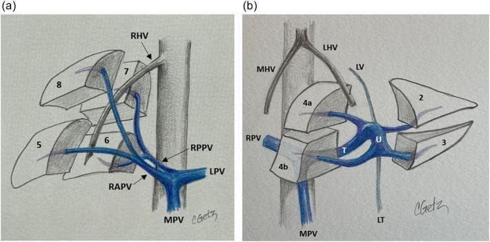 This medical anatomical diagram illustrates the segmental portal venous anatomy of the human liver, divided into two panels. Panel (a) focuses on the Right Portal Vein (RPV) branching from the Main Portal Vein (MPV). It demonstrates the bifurcation of the RPV into the Right Anterior Portal Vein (RAPV), supplying segments 5 and 8, and the Right Posterior Portal Vein (RPPV), supplying segments 6 and 7. The Right Hepatic Vein (RHV) is shown providing a boundary between these segments. Panel (b) illustrates the Left Portal Vein (LPV) anatomy, highlighting its unique structure consisting of a transverse portion (T) and an umbilical portion (U). It depicts the LPV supplying the left-sided segments 2, 3, 4a, and 4b. Key anatomical landmarks related to the LPV are labeled, including the Ligamentum Teres (LT), Ligamentum Venosum (LV), Middle Hepatic Vein (MHV), and Left Hepatic Vein (LHV). The illustration uses color coding (blue for venous, gray for hepatic veins and ligaments) to delineate vascular pathways and their relationships to the functional Couinaud segments of the liver, which are critical for surgical planning and intraoperative ultrasound orientation.