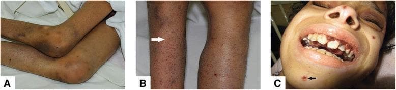 A composite of three clinical photographs demonstrating the systemic manifestations of Vitamin C deficiency (Scurvy). Panel A shows the lower extremities with prominent knee flexion contractures and diffuse ecchymoses around the joints. Panel B provides a close-up of the skin on the legs, highlighting perifollicular purpura and follicular hyperkeratosis; a white arrow points to characteristic 'corkscrew' hairs. Panel C displays the facial and oral features, including hemorrhagic gingivitis with swollen, friable, and bleeding gums. A black arrow in Panel C indicates a neurotic excoriation on the chin. The clinical findings represent the classic triad of scurvy: follicular hyperkeratosis with perifollicular hemorrhage, gingival bleeding, and musculoskeletal involvement. This content is intended for medical education regarding nutritional deficiencies and dermatologic manifestations of systemic disease.