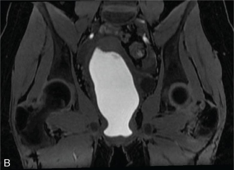 This diagnostic image is a coronal T1-weighted DIXON water MRI of the female pelvic region, illustrating significant pathology related to an imperforate hymen. The central feature is a large, hyperintense (bright), well-circumscribed structure occupying the vaginal canal and extending toward the uterine cavity. This high signal intensity on T1-weighting is characteristic of subacute hemorrhagic content, consistent with hematocolpos. The vaginal canal is markedly distended due to the accumulation of menstrual blood trapped by the distal obstruction. The surrounding pelvic anatomy, including the uterine walls and pelvic musculature, appears with lower signal intensity, providing high contrast against the centrally located fluid. This radiological presentation is classic for obstructive Müllerian anomalies in adolescent patients, where the inability to drain menstrual flow leads to progressive distention of the genital tract.