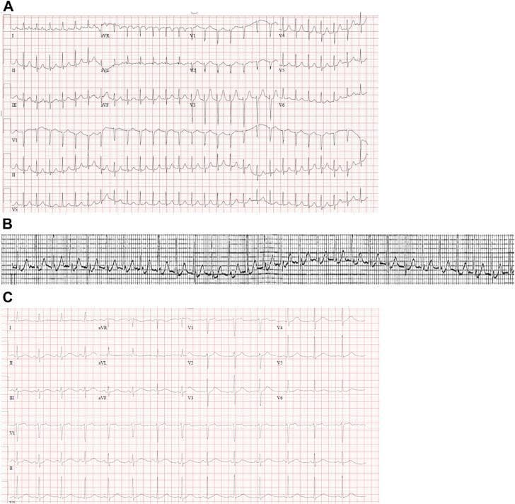 This composite diagnostic image presents a 12-lead electrocardiogram (ECG) comparison and rhythm strip illustrating supraventricular tachycardia (SVT). Panel A displays a standard 12-lead ECG showing a narrow-complex, regular tachycardia at approximately 170 beats per minute. Key diagnostic features include the absence of visible anterograde P waves and the presence of retrograde P waves, manifested as 'pseudo-r' waves' in the inferior leads (II, III, aVF), highly suggestive of Atrioventricular Nodal Reentrant Tachycardia (AVNRT). Panel B provides a continuous cardiac monitor rhythm strip, highlighting the detailed morphology of these retrograde P waves, which appear as sharp, negative deflections immediately following the QRS complexes. Panel C serves as the baseline clinical reference, showing the patient in normal sinus rhythm with a regular rate, clear anterograde P waves preceding each QRS complex, and normal waveform morphology. This comparison is an educational tool for distinguishing between normal sinus conduction and reentry-based arrhythmias, emphasizing the visual identification of retrograde conduction patterns during clinical SVT events.