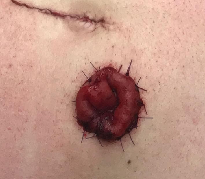 A clinical photograph showing a close-up of a newly created abdominal stoma (likely an ileostomy or colostomy). The stoma is a circular, beefy red, everted spout of bowel tissue protruding from the abdominal wall. It is fixed to the surrounding pale skin at the mucocutaneous junction using multiple interrupted polydioxanone (PDS) sutures, which are visible as dark blue or black threads placed radially. Superior to the stoma, a recent surgical incision scar is visible, appearing as a thin, raised, linear red line. The stoma tissue appears moist and well-vascularized, which is a key clinical indicator of bowel viability post-surgery. This image illustrates the surgical technique of stoma maturation, where the bowel is everted to prevent contact between fecal output and the skin, thereby reducing the risk of parastomal skin irritation and ensuring a proper fit for an ostomy pouching system.