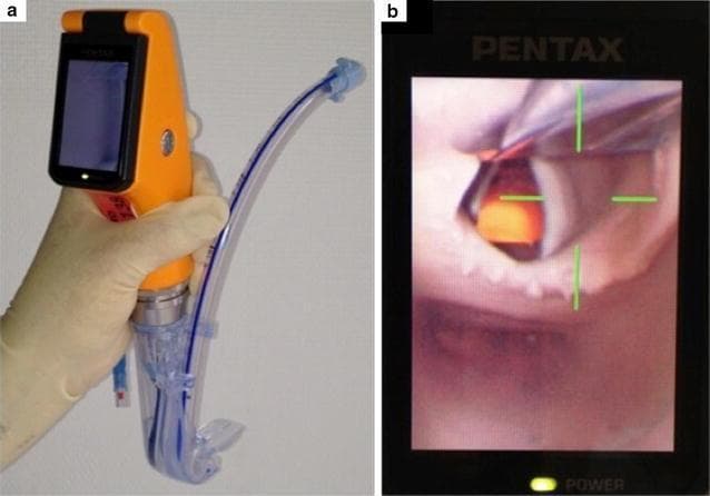 This composite image illustrates the design and clinical application of the Airway Scope® (AWS), a portable, battery-operated video-laryngoscope used for endotracheal intubation. Figure A shows the device's physical components: an orange handle with an integrated 6.1 cm LCD monitor and a single-use 'Intlock' blade. An endotracheal tube (ETT) with a blue radiopaque stripe is preloaded into the blade’s dedicated side-channel guide, which facilitates direct advancement into the trachea. Figure B demonstrates the device's functional output during indirect laryngoscopy. The LCD screen displays a real-time view of the upper airway, specifically focusing on the glottic opening. To assist the clinician, a green crosshair target is superimposed on the digital image; alignment of this target with the glottis indicates the correct path for ETT insertion. This visual aid is designed to simplify intubation by providing a wide viewing angle (180°) and clear anatomical visualization of the vocal cords, thereby potentially increasing first-pass success rates in both novice and expert practitioners.