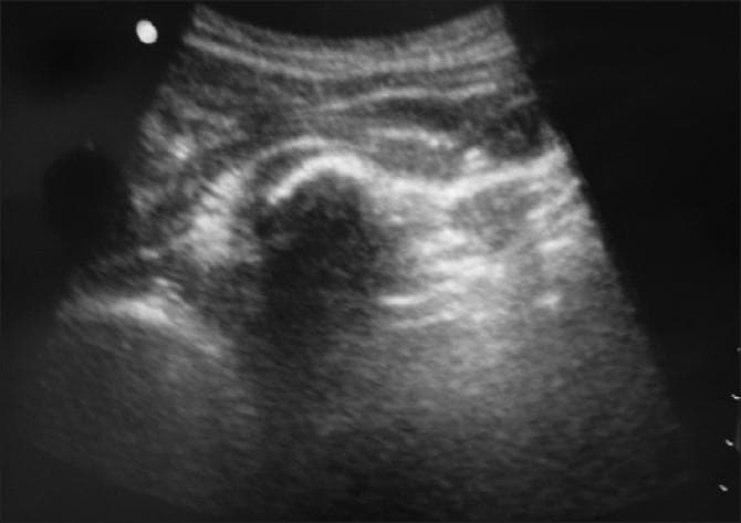 This diagnostic ultrasound image demonstrates the anatomical landmarks for a subgluteal sciatic nerve block using a curved array transducer. The image shows a transverse view of the posterior hip region. Superficial layers consist of hyperechoic subcutaneous fat and fascia immediately below the transducer surface. Deep to the fascia is the gluteus maximus muscle, characterized by an intermediate echogenic texture. In the mid-to-deep field, distinct hyperechoic bony landmarks are visible: the ischial tuberosity and the greater trochanter, which create significant posterior acoustic shadowing. The sciatic nerve is situated in the fascial plane deep to the gluteus maximus and superficial to the quadratus femoris muscle, typically appearing as an oval or elliptical structure with a honeycomb or speckled echotexture. The image serves as an educational tool for ultrasound-guided regional anesthesia, illustrating the target plane for local anesthetic injection during an out-of-plane approach for treating lower extremity orthopedic injuries.