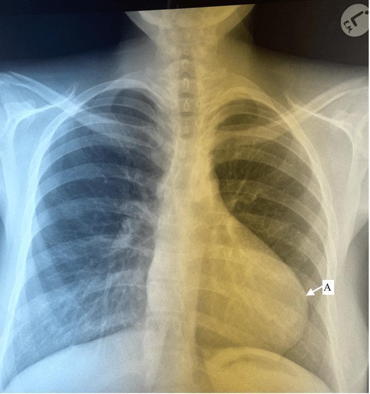 This diagnostic image is a posteroanterior (PA) chest X-ray of a pediatric patient, demonstrating classic radiographic findings of Tetralogy of Fallot. The most prominent feature is a 'boot-shaped' cardiac silhouette (coeur en sabot), characterized by an upturned apex (labeled 'A') due to right ventricular hypertrophy and a concave pulmonary artery segment (the 'waist' of the heart). The lungs exhibit generalized hyperlucency with significantly diminished pulmonary vascular markings (oligemia), suggesting decreased pulmonary blood flow secondary to right ventricular outflow tract obstruction or pulmonary stenosis. The mediastinum is narrow, and the aortic arch position is visible. Bony structures, including the ribs, clavicles, and spine, appear developmentally normal for the age group without acute pathology. This visual serves as a hallmark educational example for identifying cyanotic congenital heart disease and understanding the anatomical correlations of Tetralogy of Fallot in a clinical setting.