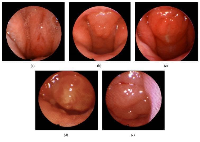 This clinical image series consists of five endoscopic frames (a through e) illustrating a grading system for adenoid hypertrophy within the nasopharynx during Drug-Induced Sleep Endoscopy (DISE). The series demonstrates the progressive narrowing of the choanae as adenoid tissue volume increases. Frame (a) shows Grade 0 (0% obstruction), characterized by a patent airway with visible scarring and no obstructive lymphoid tissue. Frame (b) depicts Grade 1 (<40% obstruction) with a small, relatively smooth tissue mass. Frame (c) shows Grade 2 (41%–70% obstruction), featuring an enlarging, more prominent adenoid mass. Frame (d) illustrates Grade 3 (71%–90% obstruction), where the nodular tissue significantly fills the airway space. Frame (e) represents Grade 4 (91%–100% obstruction), showing severe hypertrophy where the adenoid tissue nearly or completely occludes the airway, contacting the soft palate. This sequence is used in otolaryngology for assessing the severity of obstructive sleep apnea (OSA) and planning pediatric airway interventions.