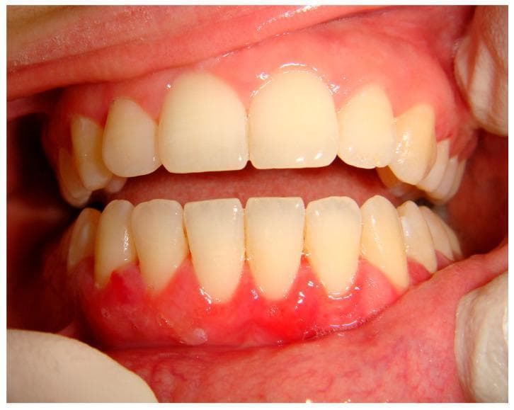 This intraoral clinical photograph displays diffuse desquamative gingivitis affecting the mandibular (lower) arch. The gingiva exhibits intense erythema, inflammation, and a loss of normal stippling, appearing smooth and friable. The desquamative process is concentrated at the marginal and attached gingiva, characterized by a 'peeling' or thinned epithelial appearance. Notably, the severity of the gingival inflammation exists despite a relatively low accumulation of dental plaque or calculus, which is a classic clinical indicator that the pathology is systemic or autoimmune rather than purely plaque-induced. This specific presentation is identified as a manifestation of mucous membrane pemphigoid (MMP), a chronic autoimmune blistering disease. The educational focus is on recognizing desquamative gingivitis as a clinical sign of underlying mucocutaneous disorders, necessitating biopsy and immunofluorescence for definitive diagnosis.