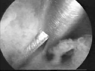This monochrome diagnostic clinical image captures a hysteroscopic view of an intrauterine adhesiolysis procedure. The visual field demonstrates intrauterine adhesions, also known as Asherman Syndrome, appearing as cloudy, whitish, irregular fibrous bands and bridges of tissue within the uterine cavity. The surrounding endometrial tissue exhibits a granular, darker texture. A polished, reflective metallic hysteroscopic scissor is actively engaged in 'cold-knife' dissection of the adhesive structures. The instrument has a slim, sharp-edged profile designed for precise mechanical cutting without the use of electrosurgical energy, thereby minimizing thermal damage to the residual endometrium. This procedural image illustrates a key surgical intervention for restoring uterine cavity morphology to address symptoms such as infertility, amenorrhea, or cyclic pelvic pain.