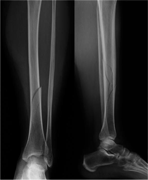 Two-view pre-operative X-ray (Anteroposterior and Lateral) of a left lower leg demonstrating fractures of the tibia and fibula. The tibial fracture is a spiral/oblique diaphyseal fracture (AO 42-A1) located at the junction of the middle and distal thirds. On the AP view, there is lateral displacement and angulation of the distal tibial fragment. The lateral view reveals a posterior displacement of the distal fragment with evidence of cortical comminution. Additionally, a distal fibular fracture (AO 44-B1) is visible near the level of the syndesmosis, appearing non-displaced on these views. Soft tissue swelling is noted around the fracture sites and the ankle joint. This imaging is characteristic of trauma-induced lower limb fractures requiring orthopedic evaluation for stabilization, such as intramedullary nailing or open reduction internal fixation.