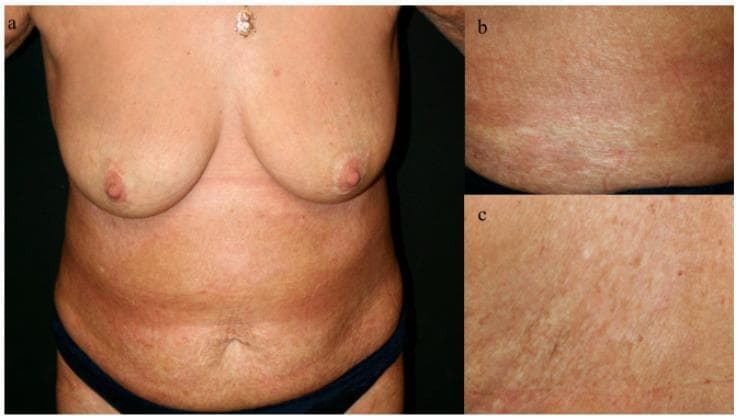 Clinical photograph series (a-c) showing the anterior torso, breasts, and abdomen of a patient after 18 months of treatment for bullous morphea. Image 'a' provides a panoramic view of the torso, demonstrating significant resolution of active bullous lesions and erosions. The skin exhibits post-inflammatory pigmentary changes, including generalized erythema, areas of hyperpigmentation, and atrophic, ivory-colored patches characteristic of sclerodermatous remission. Close-up views 'b' and 'c' highlight the residual skin texture and morphology. Image 'b' shows linear, ivory-white sclerotic markings and shiny fibrosis, while 'c' emphasizes a coarse texture with closely compacted fine lines and superficial atrophic changes. Key educational features include the absence of active bullae or acute inflammatory plaques, indicating successful therapeutic management with budesonide. The clinical presentation reflects a rare association between bullous morphea and autoimmune hepatitis, with the images illustrating the skin's progression to a stable, chronic state with persistent scleroderma-like fibrosis and skin laxity.