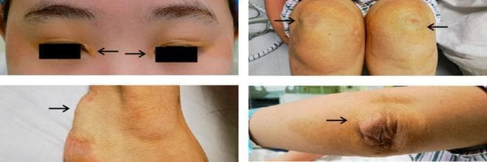 This composite clinical photograph displays multiple cutaneous manifestations of xanthomas in a patient with homozygous familial hypercholesterolemia. The image is divided into four panels, each highlighting a different anatomical region with arrows pointing to the pathology. Top left: Ocular region showing xanthelasma palpebrarum, characterized by yellowish, slightly raised plaques on the upper and lower eyelids. Top right: Bilateral patellar region demonstrating tuberous xanthomas, which appear as firm, yellowish-orange nodules over the knees. Bottom left: Posterior view of the ankle showing a prominent tendon xanthoma of the Achilles tendon, presenting as a large, subcutaneous nodular thickening. Bottom right: Cubital fossa/elbow region showing a tuberoeruptive xanthoma with a wrinkled, raised, yellowish appearance over the extensor surface. Collectively, these findings illustrate the systemic deposition of cholesterol-rich material in skin and tendons, serving as a hallmark diagnostic sign for severe primary hyperlipidemia and associated cardiovascular risk.