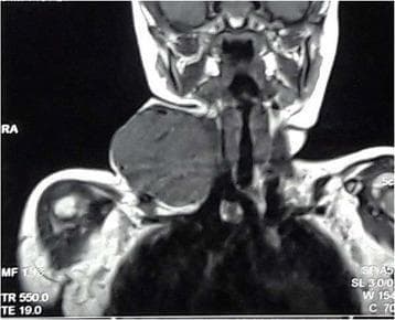 Coronal T1-weighted MRI of the neck and upper thoracic region demonstrating a large, well-circumscribed, ovoid soft tissue mass in the right lateral neck. The mass exhibits heterogeneous intermediate signal intensity. It is located in the posterior triangle and infrahyoid region, extending from the level of the mandible superiorly toward the supraclavicular fossa inferiorly. The lesion causes significant lateral displacement of the overlying soft tissues and appears to exert mass effect on adjacent structures, including the right sternocleidomastoid muscle and potentially the carotid sheath components. The trachea remains midline. This imaging is characteristic of a high-flow vascular malformation or a hypervascular neoplastic process, such as a glomangiomyoma or hemangiopericytoma-like tumor. The absence of flow voids within the bulk of the mass on this sequence, combined with its heterogeneous texture, highlights its complex tissue composition. This diagnostic image is intended for educational use in radiology and head and neck surgery, focusing on the differential diagnosis of pediatric neck masses.