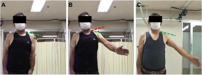 This clinical photograph sequence illustrates compensatory movement patterns in a patient with deltoid muscle weakness during shoulder rehabilitation. The images demonstrate the 'shrugging motion' used to achieve arm elevation. (A) Baseline/Resting state: The green dashed line indicates the neutral anatomical position of the acromion and scapula with the arm at the side. (B) Compensatory motion: During early rehabilitation, the patient attempts arm abduction, resulting in excessive superior migration of the scapula and acromion (indicated by the red dashed line) above the baseline. This 'shrug' signifies over-reliance on the upper trapezius to compensate for deficient deltoid strength. (C) Improved motor control: Following intervention, the patient achieves similar arm elevation while maintaining the acromion at the baseline level (green dashed line), indicating successful isolation of the glenohumeral joint and reduction of compensatory shrugging. The images are used to teach clinical assessment of scapulohumeral rhythm and the evaluation of rehabilitation progress in neuromuscular shoulder dysfunction.