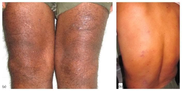 Clinical photographs showing dermatological manifestations of borderline lepromatous leprosy. Panel (a) displays the anterior lower extremities, highlighting a shiny, atrophic plaque on the left knee with overlying xerosis and mild desquamation, which had been previously misdiagnosed as steroid-modified psoriasis. Panel (b) shows the patient's posterior trunk (back) featuring multiple discrete, erythematous plaque-like lesions. These lesions represent cutaneous involvement in Hansen's disease, mimicking clinical psoriasis. The presentation is significant for medical education as it demonstrates the 'great imitator' quality of leprosy, where skin plaques and symmetric polyarthritis can lead to a misdiagnosis of psoriatic arthritis or seronegative rheumatoid arthritis. The morphological features include erythema, induration, and surface changes that are characteristic of type 2 lepra reactions (Erythema Nodosum Leprosum) in the context of chronic polyarthritis.