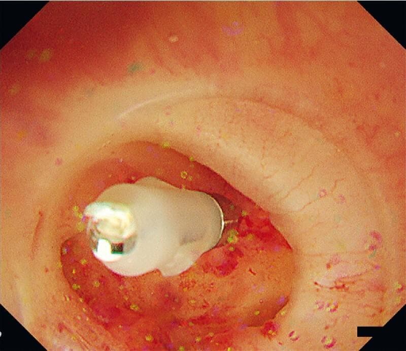 This clinical photograph shows an endoscopic view of the right colon during a colonoscopy procedure for diverticular bleeding. The image highlights a colonic diverticulum being managed with a short-armed hemostatic clip. The metallic clip is seen applied directly to a visible vessel within the mucosal pocket to achieve pinpoint hemostasis. The surrounding mucosa appears erythematous and irregular, with visible red patches consistent with recent hemorrhage or local inflammation. A transparent hood attached to the colonoscope tip is visible in the foreground, utilized to stabilize the working space and facilitate water inflation to open the diverticulum for better visualization. This image demonstrates the technical application of endoscopic clipping for the treatment of lower gastrointestinal bleeding associated with colonic diverticulosis.